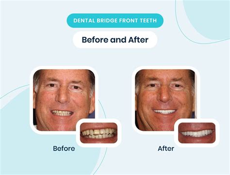 Understanding Dental Bridge Cost with Insurance: A Guide to Affordable Tooth Replacement